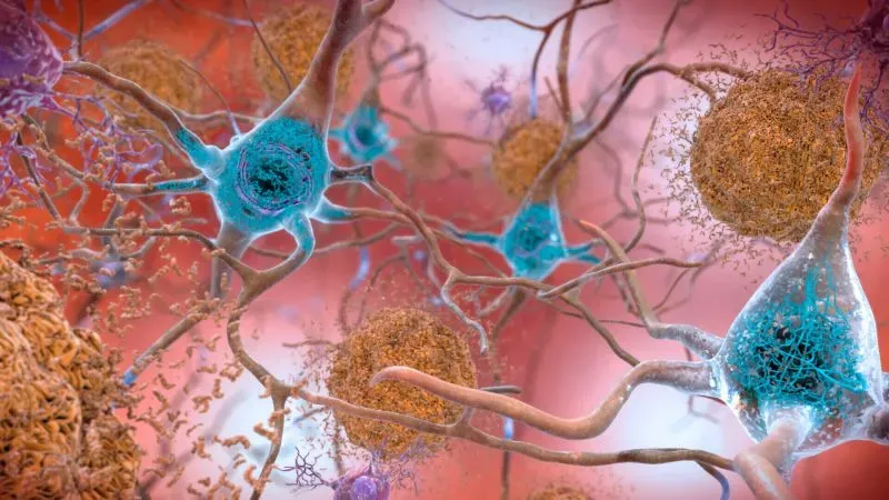 صورة توضح خلايا عصبية في الدماغ مع تجمعات من بروتينات الأميلويد، مما يشير إلى علامات مرض الزهايمر وتدهور الذاكرة.