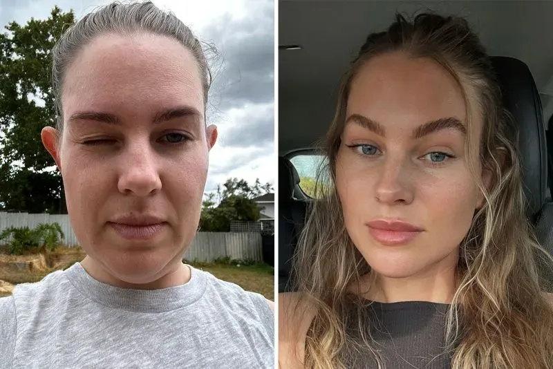 صورة تظهر كيم هابرلي قبل وبعد عملية شد الوجه، حيث تُظهر اليمين وجهها المتورم مع شقوق جراحية، بينما تُظهر اليسار مظهرها بعد الشفاء.