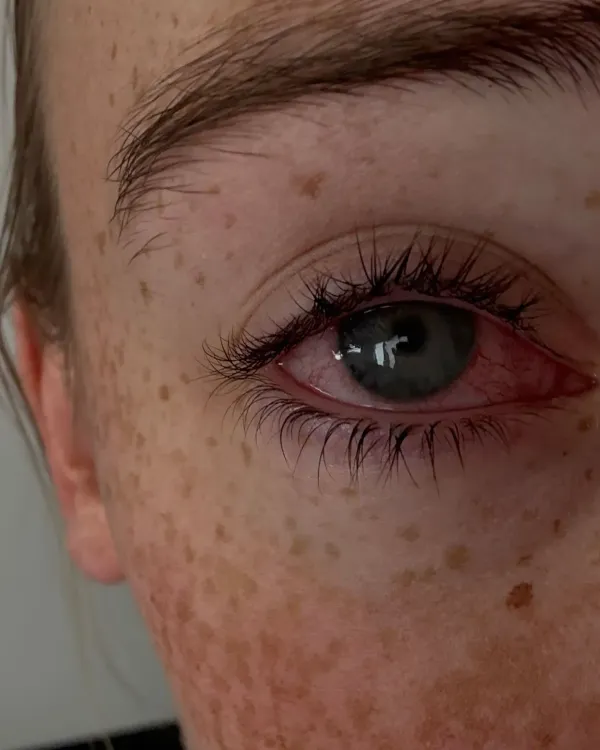 عين حمراء ومتورمة تظهر أعراض التهاب القرنية الشوكميبا، مع بقع داكنة حول العين، مما يعكس حالة صحية خطيرة تتطلب العناية الطبية.