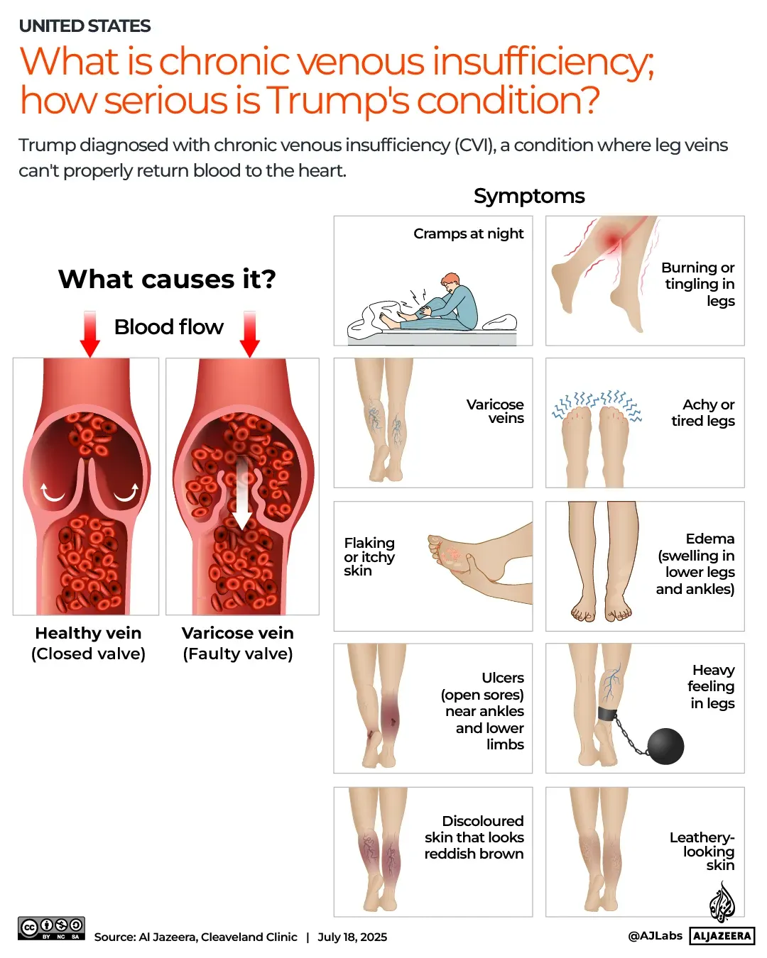 تشخيص الرئيس ترامب بالقصور الوريدي المزمن (CVI) يظهر تأثيره على تدفق الدم في الساقين، مع أعراض مثل التورم والدوالي.